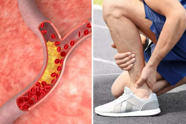 Cholesterol cao: Lưu ý dấu hiệu cảnh báo này ở chân cực nguy hiểm, chớ để kéo dài gây đột quỵ  - Ảnh 2